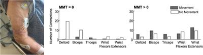 Muscle Activity After Stroke: Perspectives on Deploying Surface Electromyography in Acute Care